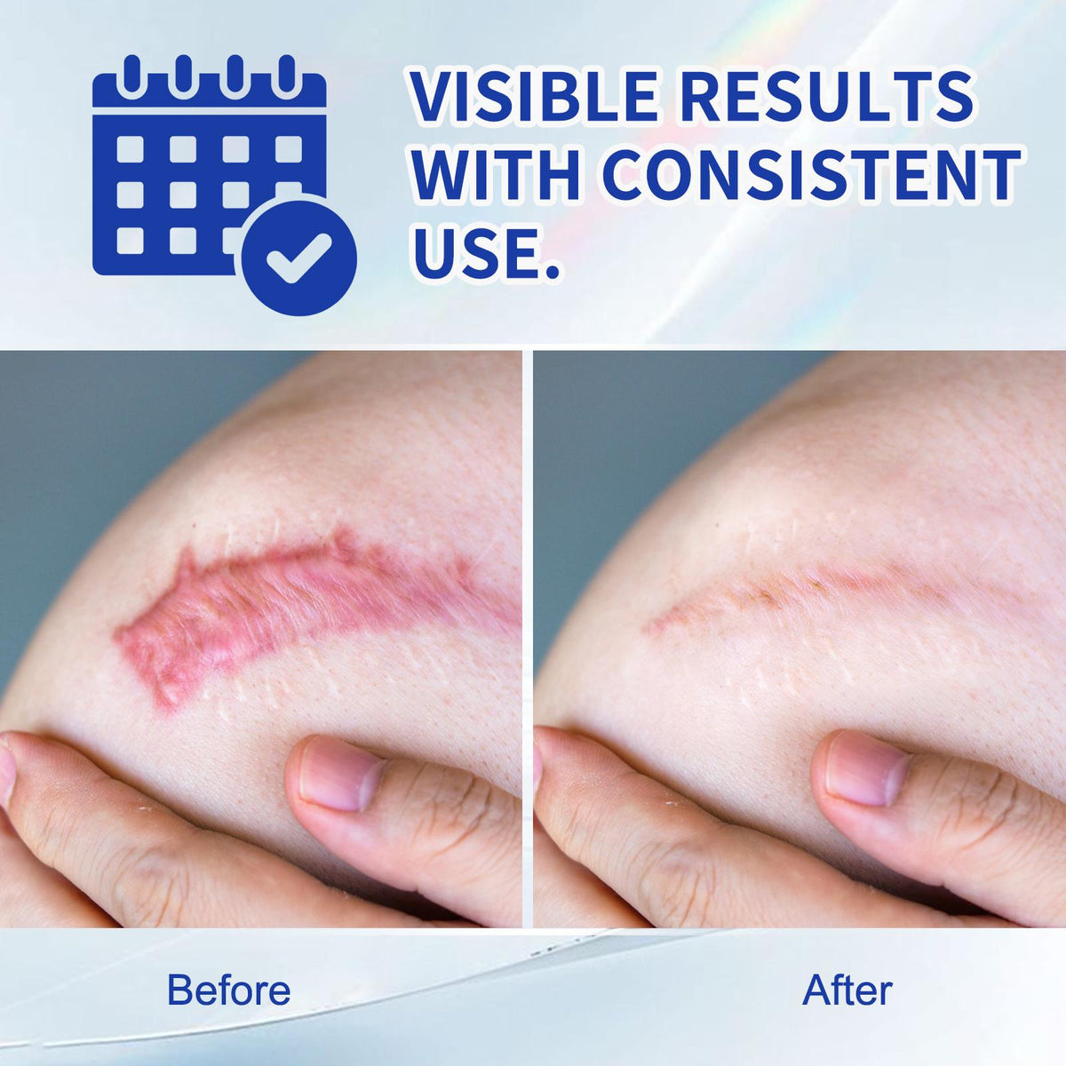 ScarEase Silicone Scar Gel