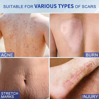 ScarEase Silicone Scar Gel