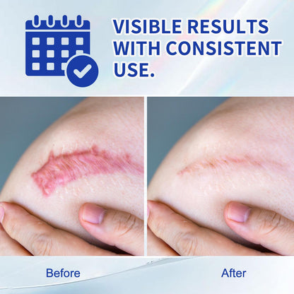 ScarEase Silicone Scar Gel