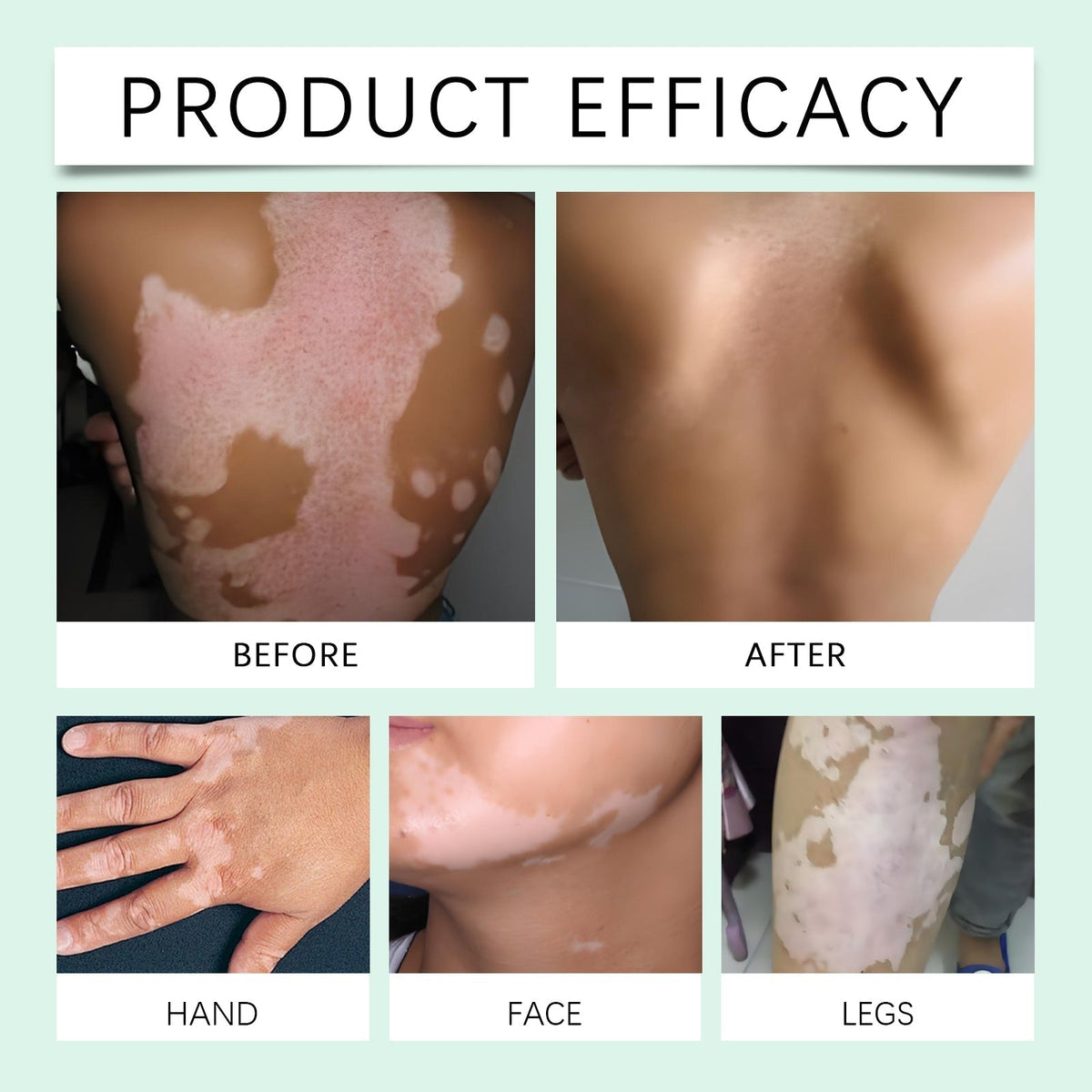 Dermacare Vitiligo Herbal Aloe Vera & Mint Care Cream